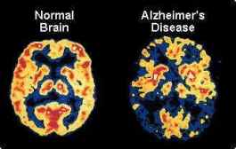 alzheimers-disease